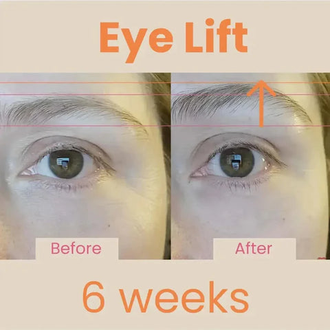 EvenSkyn® Venus Eyelid Anti-Aging Device