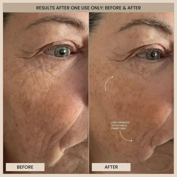 EvenSkyn® Lumo: Premium Anti-Aging & Skin Tightening Handset (2025)